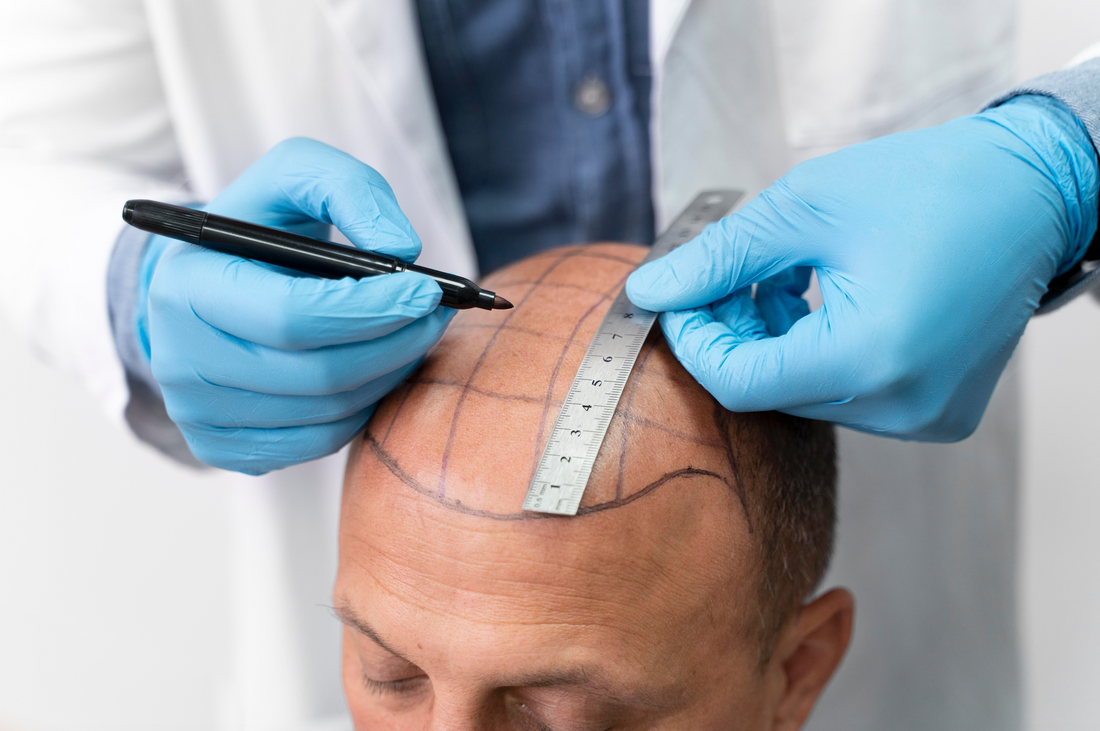 image représentant une greffe de cheveux sur un homme